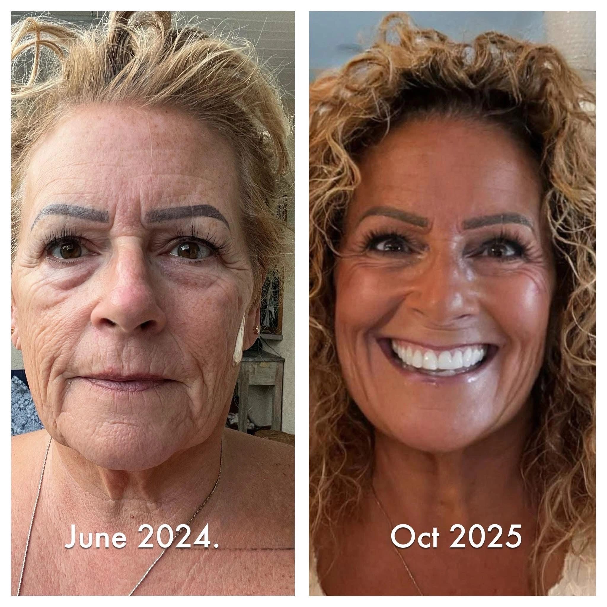 LifeWave X39 phototherapy patches before and after, June 2024 and October 2025