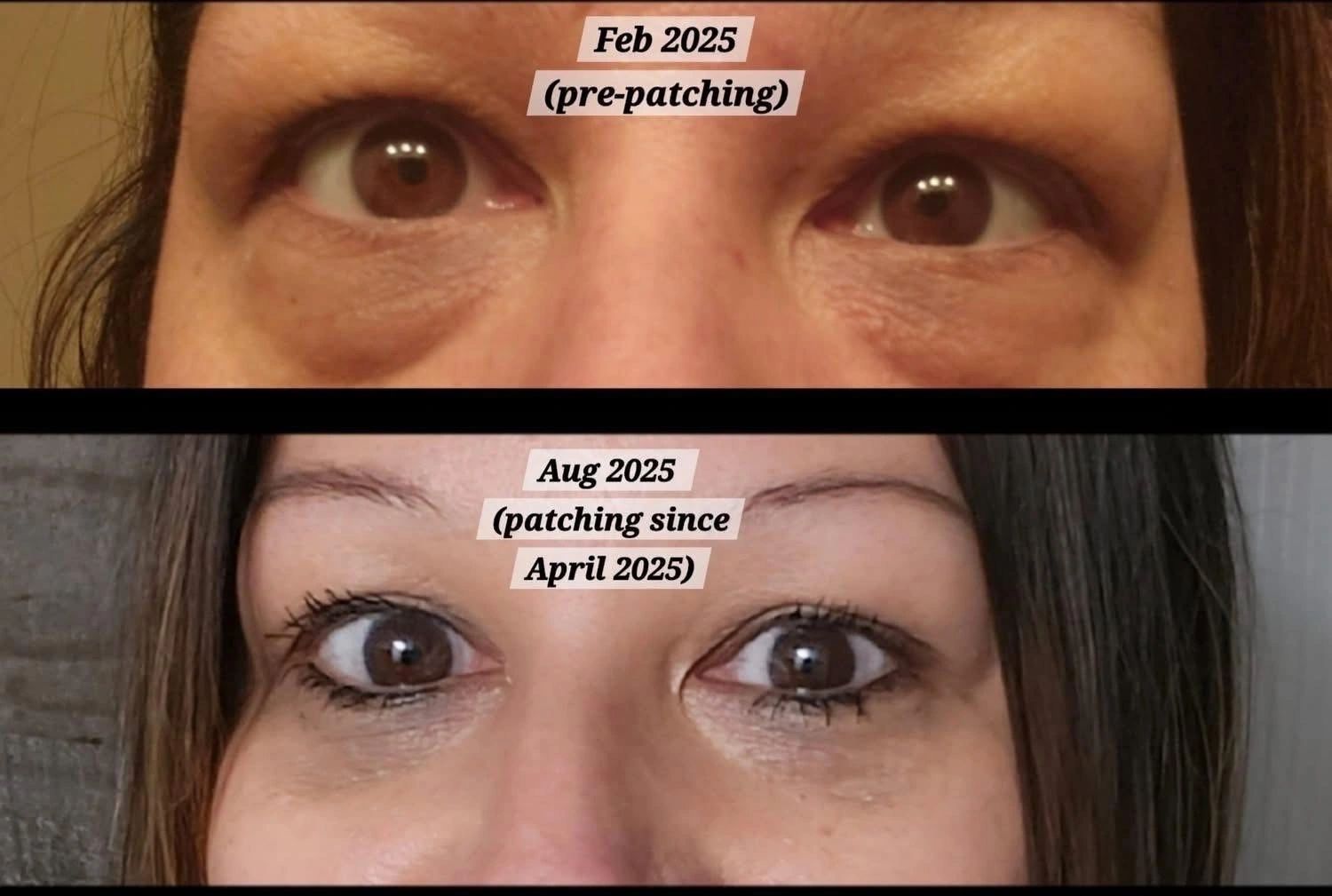 Eye area before and after LifeWave X39 patches, February 2025 to August 2025
